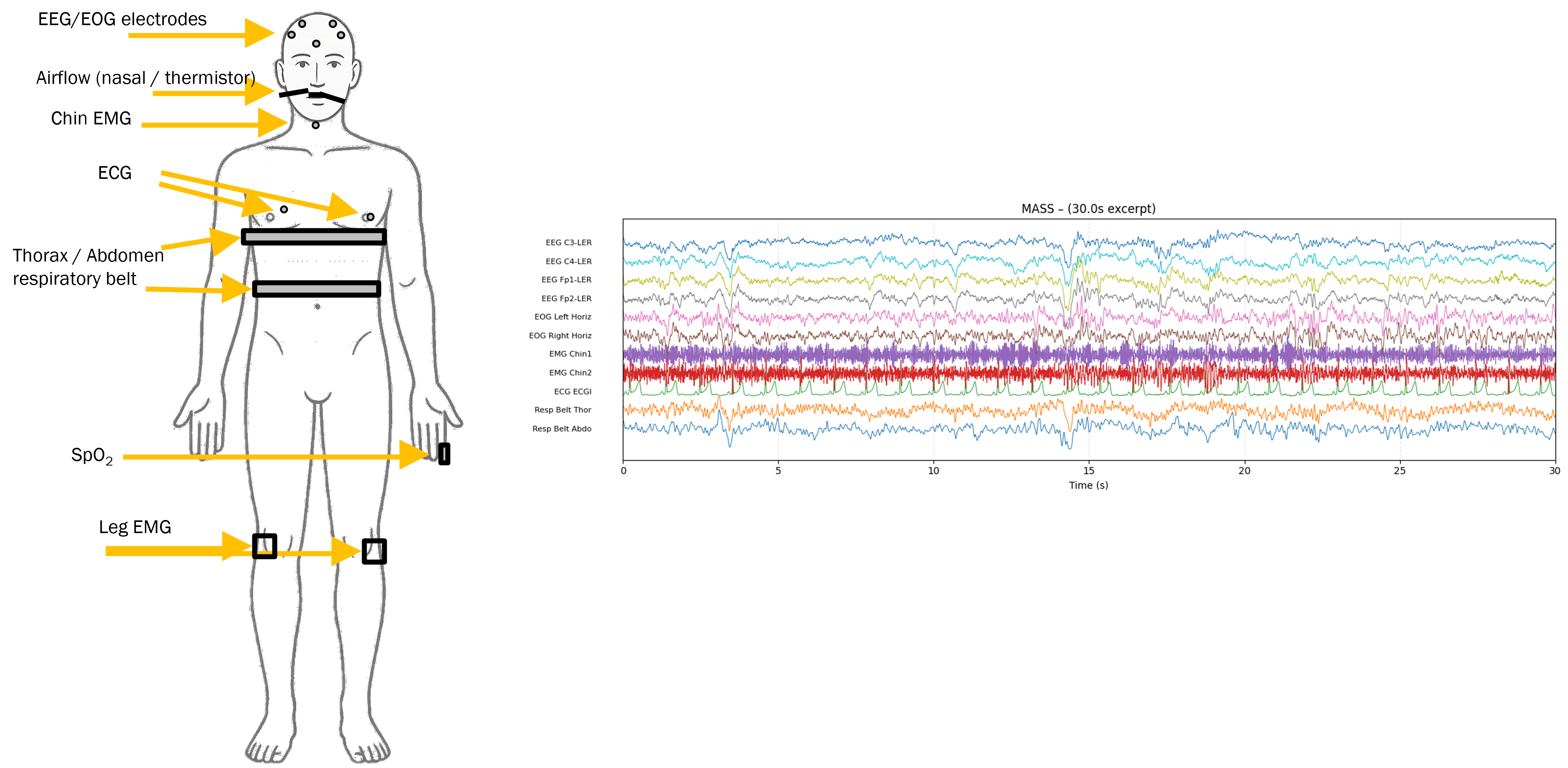 PSG montage and an example 30-second multi-channel signal segment from MASS. EEG/EOG electrodes capture brain and eye activity; chin and leg EMG capture muscle tone; ECG, respiratory belts, airflow, and SpO₂ capture cardiorespiratory state.